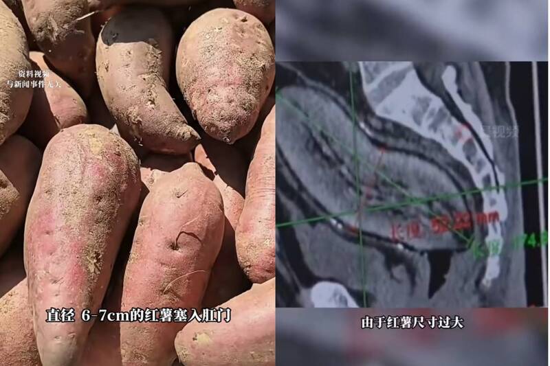 PLAY948-熱門新聞-真的沒在開玩笑！61歲大爺深夜往肛門塞「17公分巨型地瓜」，醫護看傻眼：腸子差點被撐爆！